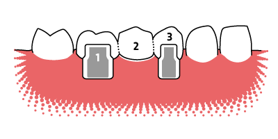 Aufbau einer 3-gliedrigen Endpfeiler-Zahnbrücke Veranschaulichung des Aufbaus einer Zahnbrücke