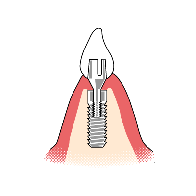 Aufbau eines Zahnimplantats mit Krone Veranschaulichung des Aufbaus eines Zahnimplantats  und der dazugehörigen Suprakonstruktion