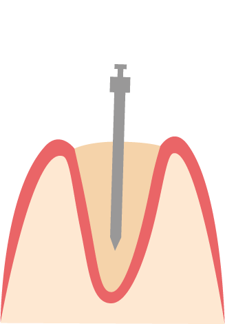 Doppelkrone: Primär- und Sekundärteleskope Funktion von Kronen, die mittels Teleskopen befestigt werden