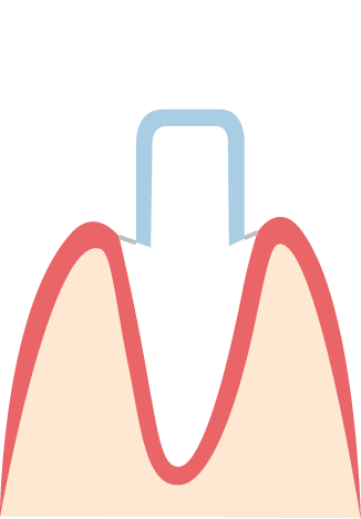 Doppelkrone: Primär- und Sekundärteleskope Funktion von Kronen, die mittels Teleskopen befestigt werden