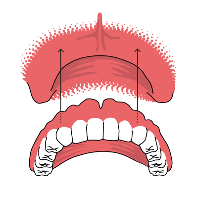 Totalprothese, die Dritten Veranschaulichung der Funktionsweise einer Totaleprothese